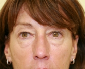 Feel Beautiful - Eyelid Surgery San Diego Case 47 - Before Photo